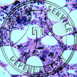 Bone Marrow Slide HC1-14 Bone marrow; section demonstrating phagocytic cells filled with carbon.