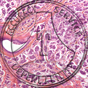 Mammary Cancer Prepared Microscope Slide