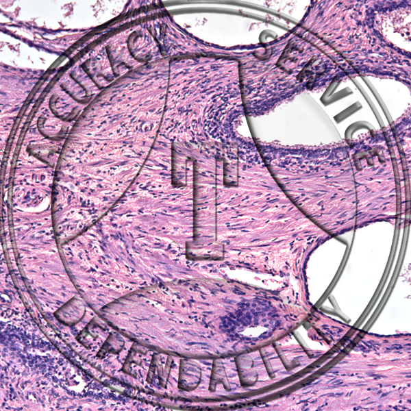 Prostatitis Slide HM5-34 Genital system: male prostate; prostatitis, human, section.